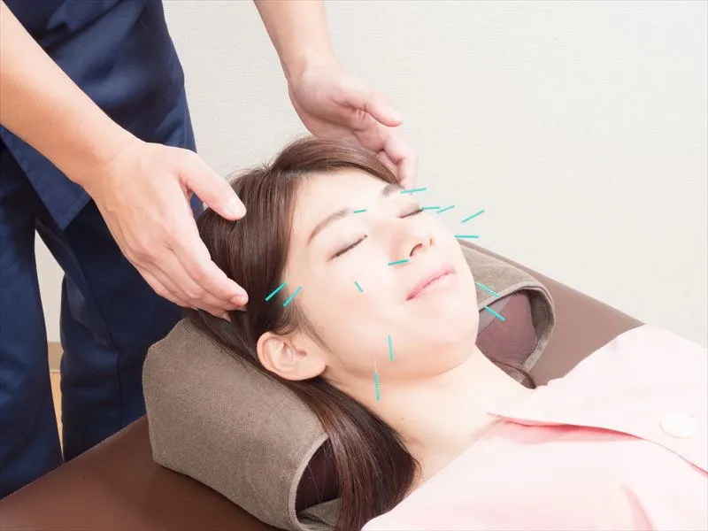 美容鍼効果の持続時間はどのくらい？