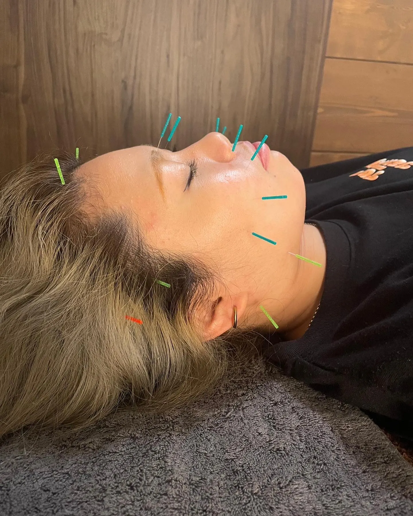 美顔鍼なら当院へ！！