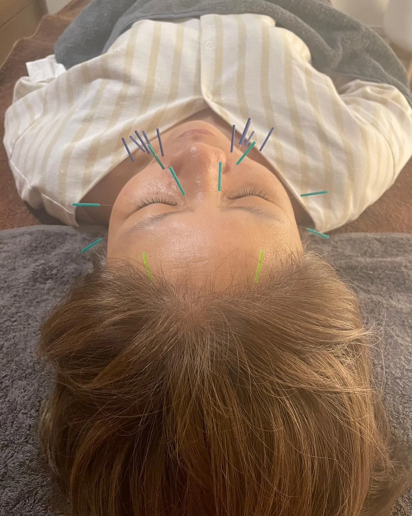 美顔鍼なら当院へ！！