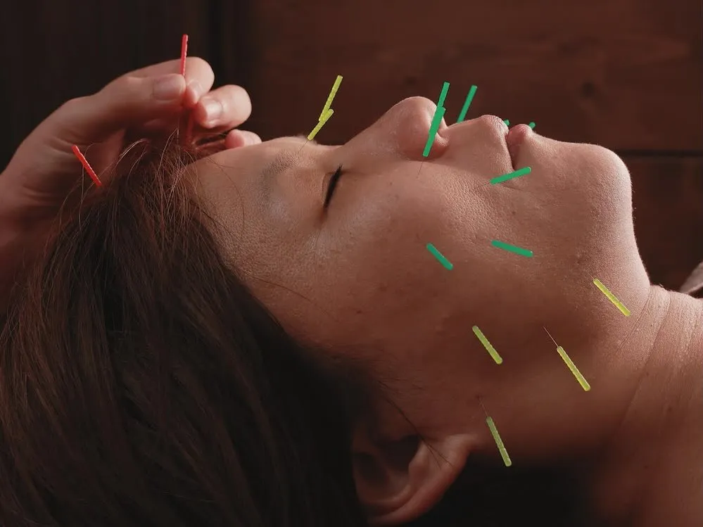 美容鍼なら当院へ！