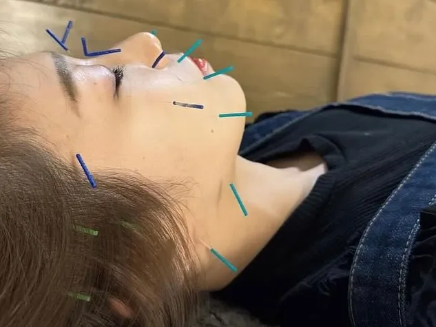 美容鍼なら当院へ！