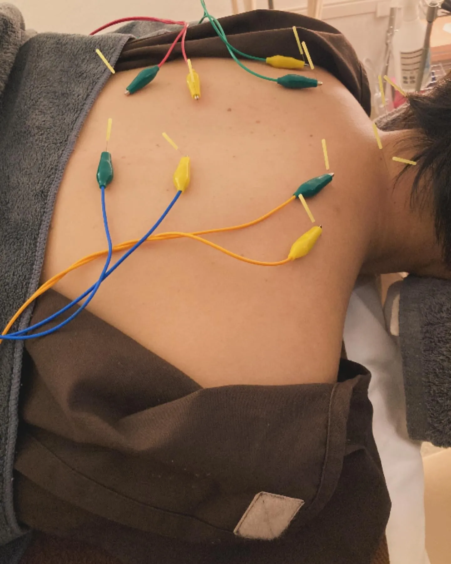 鍼灸施術もオススメです！