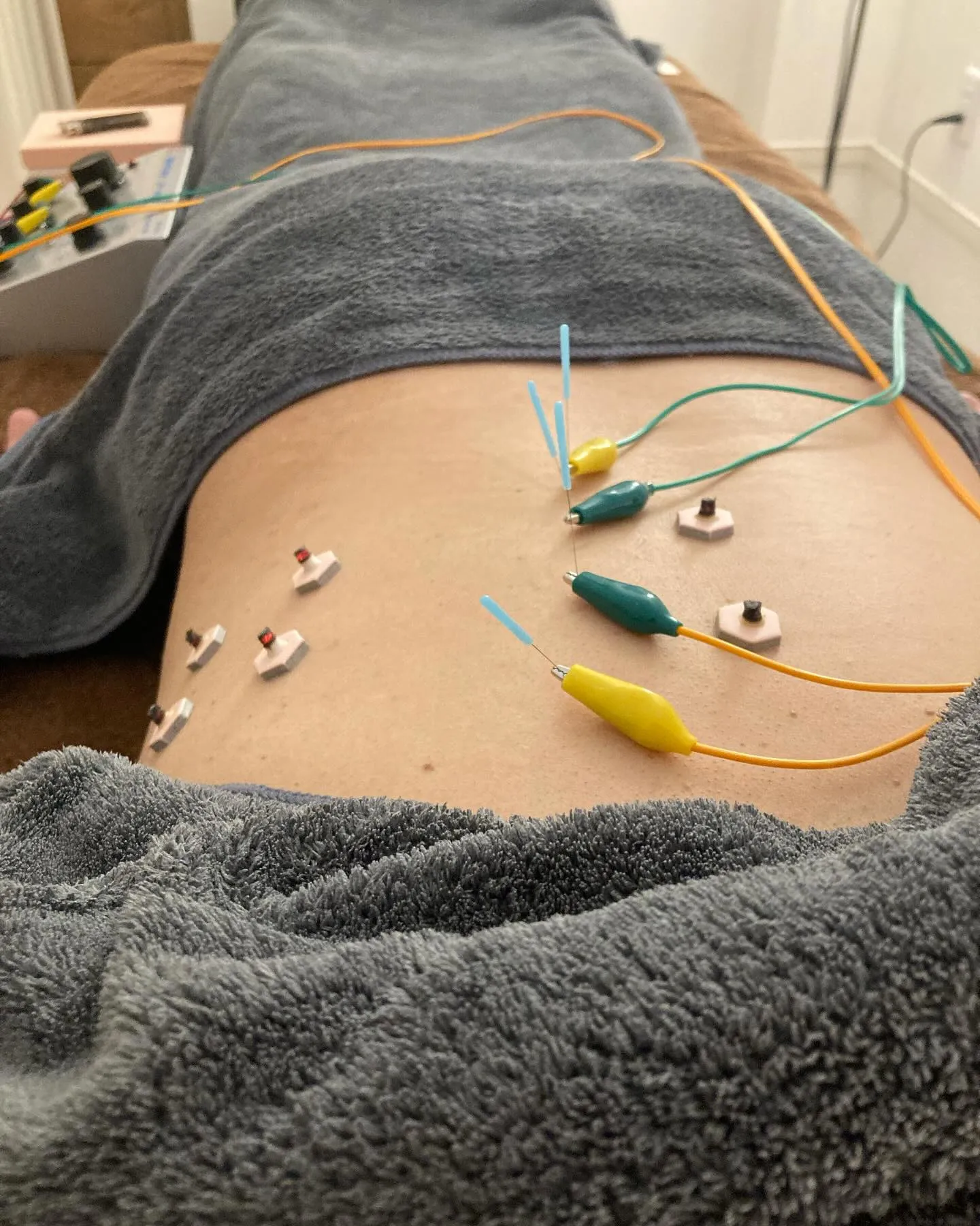 鍼灸施術でお身体の改善！