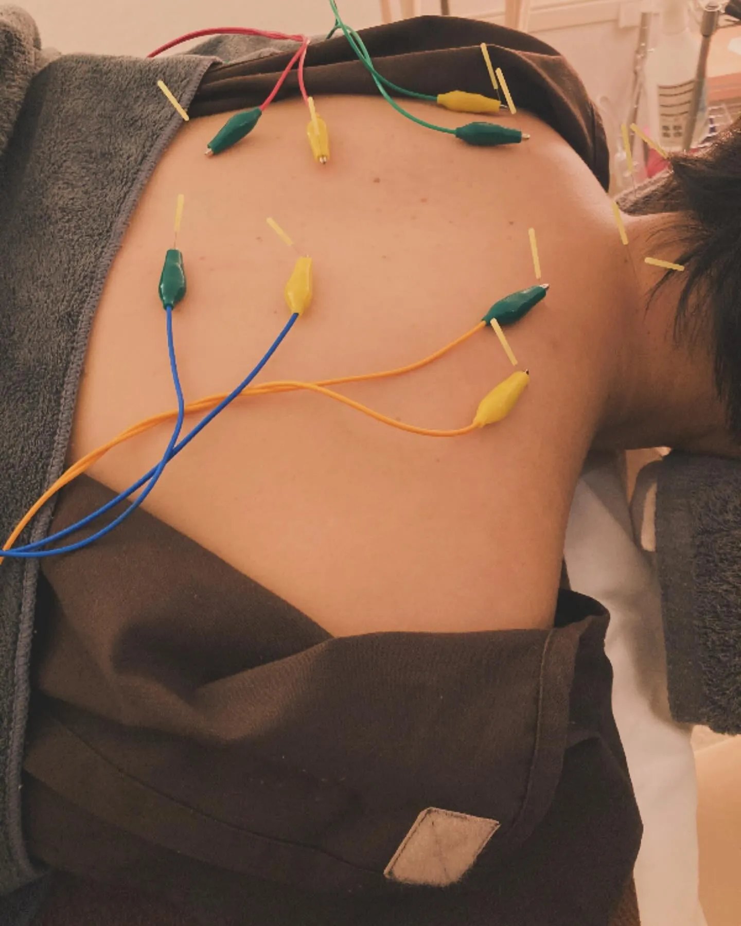 鍼灸で体質改善！