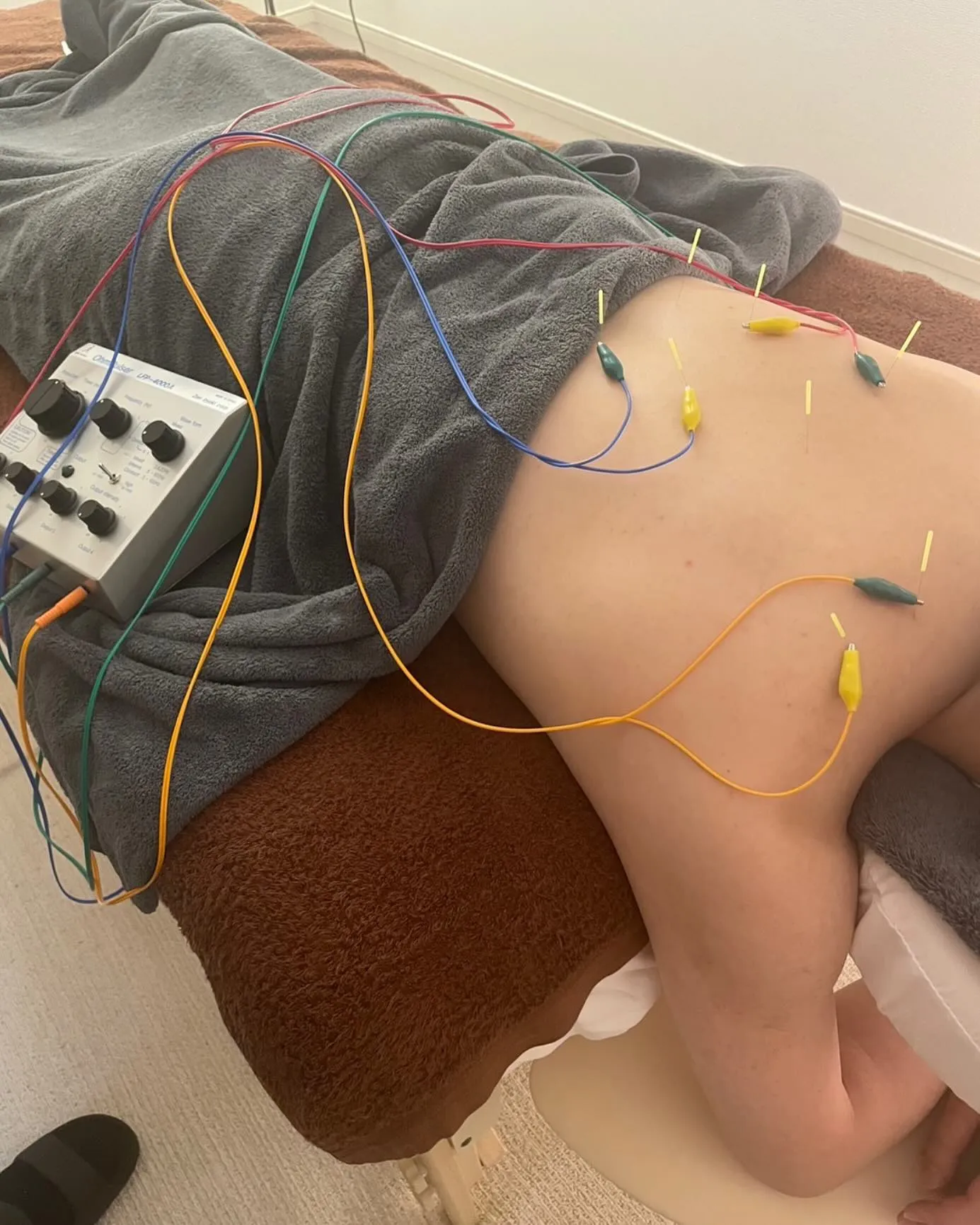 鍼灸で肩こり改善！