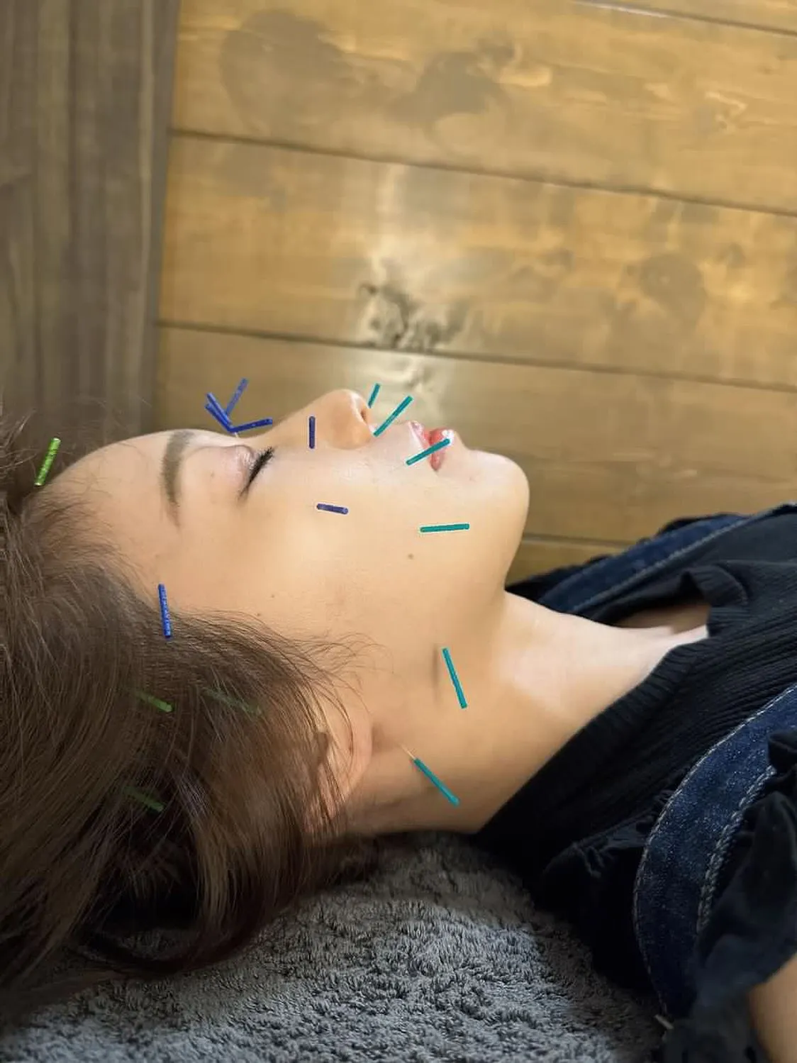 ✨美容鍼はこんな方におすすめ✨